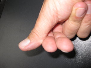 Double Thumb rechte Hand.JPG
